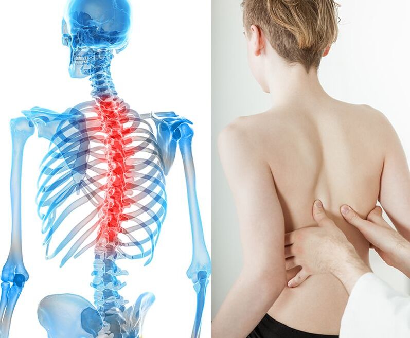 как да се лекува гръдна остеохондроза