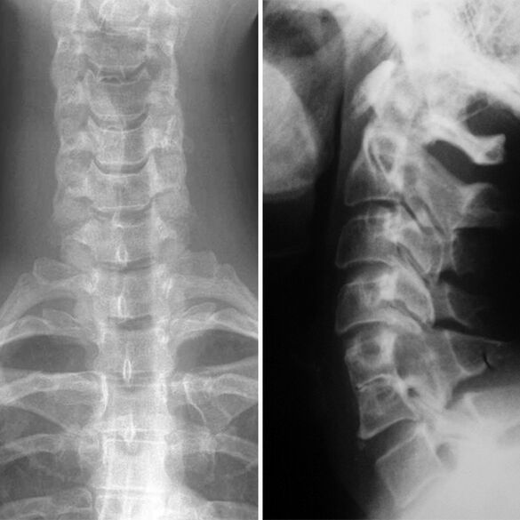 X -ray на шийния гръбначен стълб
