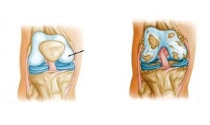 патологични промени в артрозата на коляното