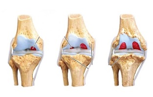 стадии на артроза на колянната става