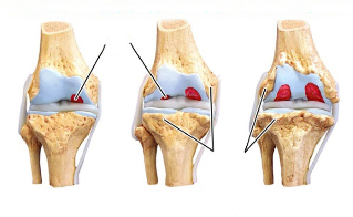 стадии на артроза на коляното