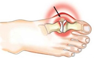 Възпаление на ставата между палеца и ходилото при артрит