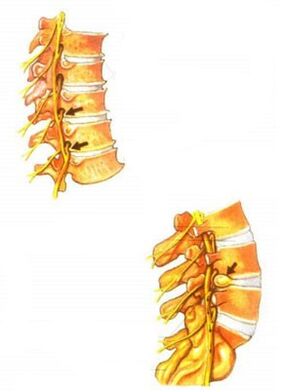 илюстрация на остеохондроза на гръбначния стълб