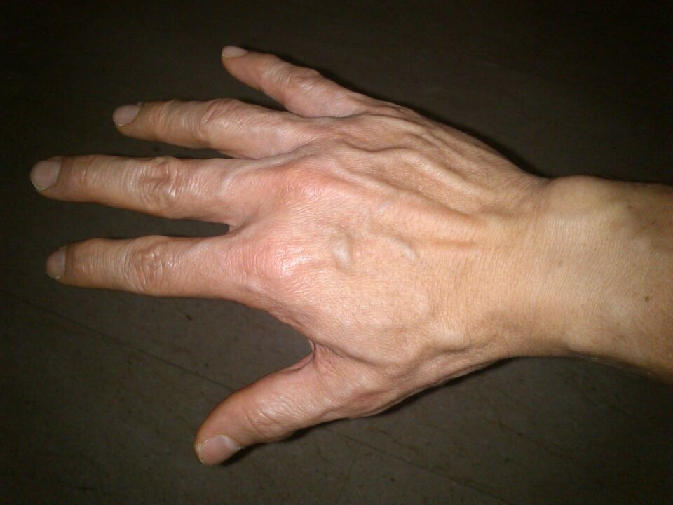 деформация на костите и болка в ставите на пръстите