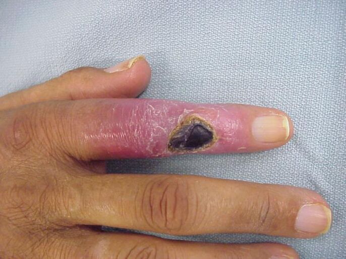 остеомиелит като причина за болка в ставите на пръстите