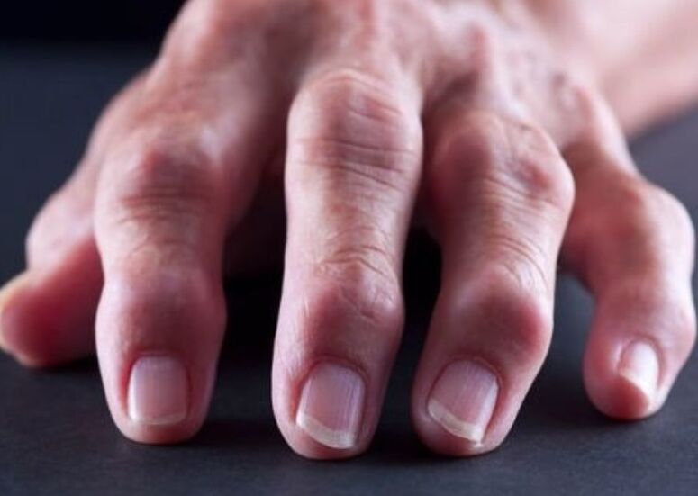 ревматоиден артрит като причина за болка в ставите на пръстите