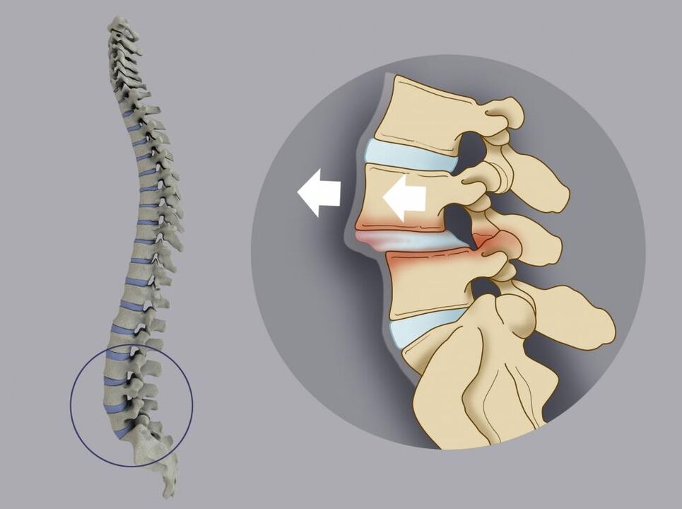 изместване на прешлените като причина за болки в гърба