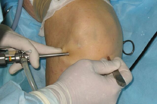 артроскопия за болки в коляното